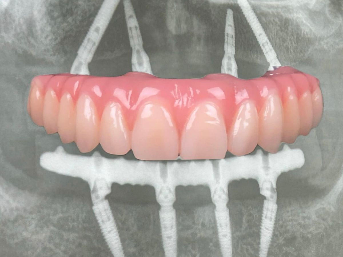 Fix on four Implantate – Ergebnis